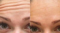 Botox