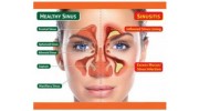 Sinus Surgery