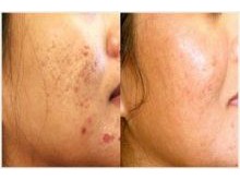 Laser Resurfacing