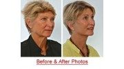 Facelift